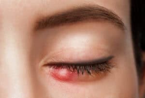 Eyes of a girl with Chalazion close-up. Acute purulent inflammation of the hair follicle of the eyelashes of a young woman. Treatment and prevention of eye diseases.