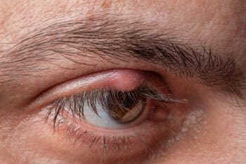 red bump on the upper eyelid