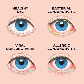 illustration differences between conjunctivitis
