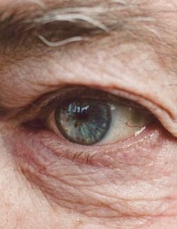Close-up of the eye of an old person having AMD, Age-related Macular Degeneration