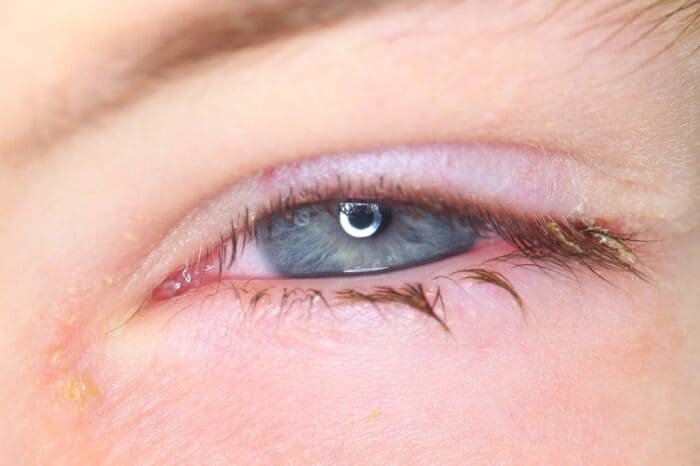 Close-up of a sticky eye.