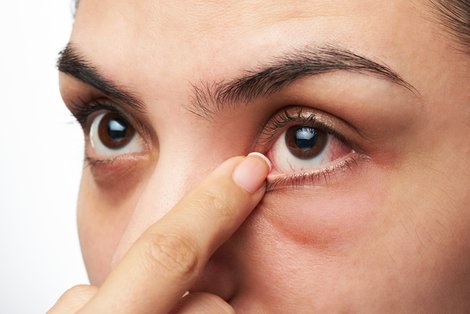 Close up of woman's eye having sand sensation, Meibomian Gland Dysfunction