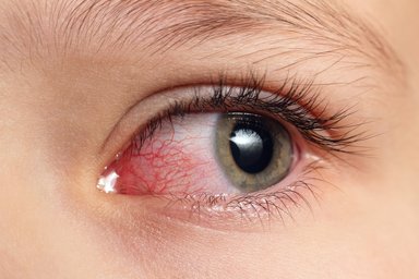 Closeup irritated infected red bloodshot eyes,