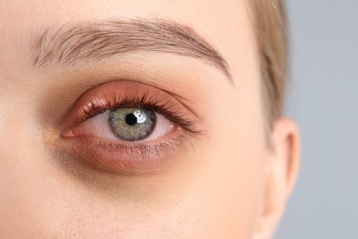 Woman suffering from eye burning sensation.