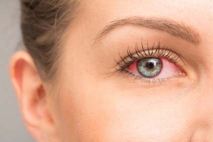 Woman having red eye because of irritation