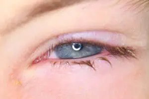 Bacterial conjunctivitis